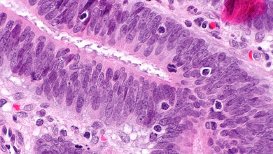 Dickdarmkrebs_mit_Lymphozyten_Nephron_Eigenes_Werk__CC_BY_SA_3_0_Wikimedia.jpg Dickdarmkrebs mit Lymphozyten im Tumor, HNPCC