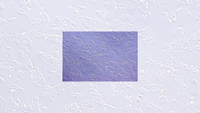 FOXR2_produzierende_Neuroblastom_Zellen__Schmitt_Hoffner_KiTZ.jpg Neuroblastom-Zellen