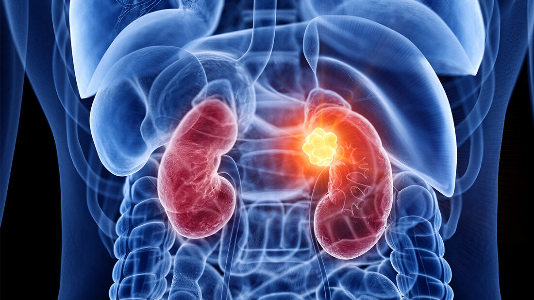  Geringere Produktion von HIRA verantwortlich für Nierenkrebs? 