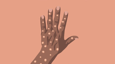 Hand mit Mpox