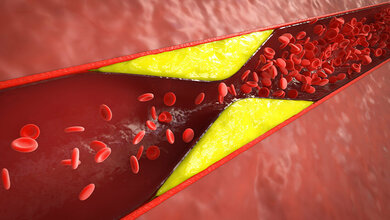 Erprobungsstudie zur koronaren Lithoplastie bei koronarer Herzkrankheit