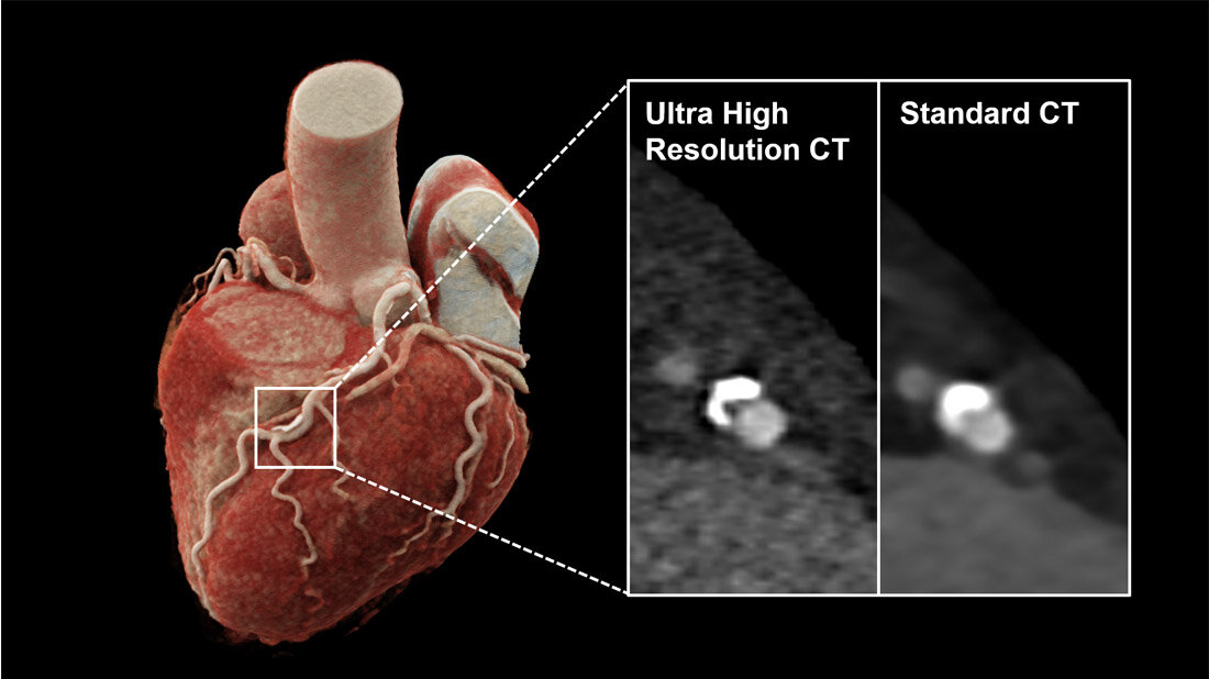3D-Rekonstruktionen einer Computertomografie des Herzens