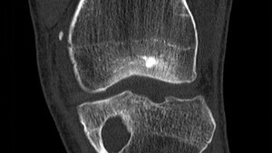 Knie-MS-CT