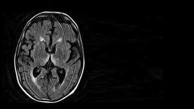 Kardiologische und  neurologische  Auswirkungen einer Alkoholerkrankung