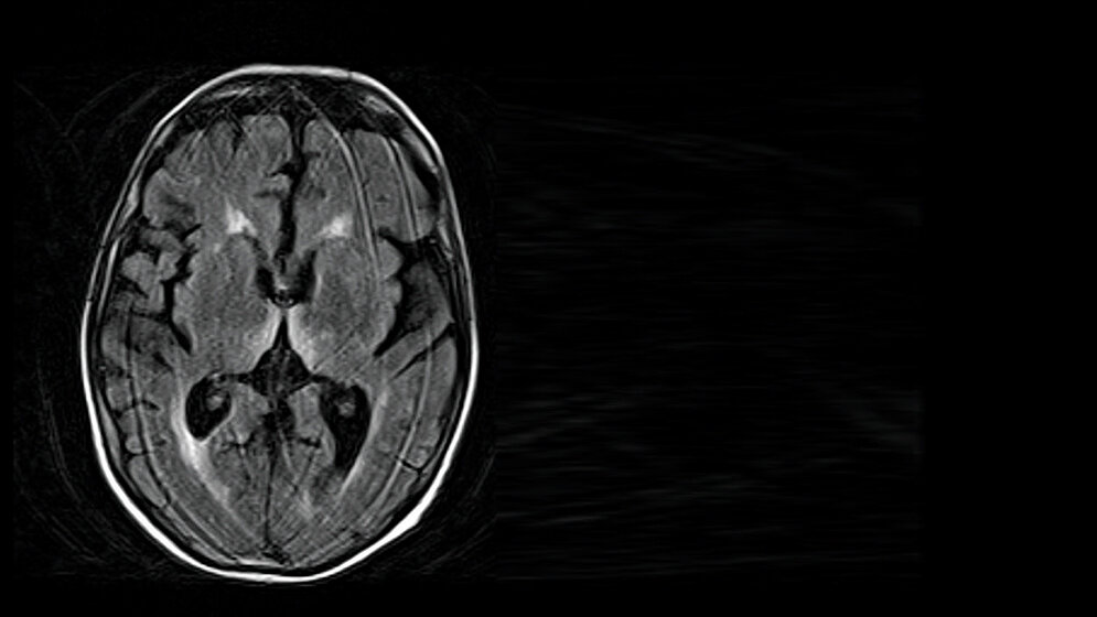 Kardiologische und  neurologische  Auswirkungen einer Alkoholerkrankung