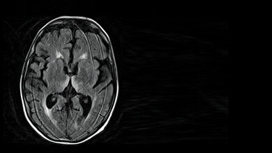 Kardiologische und  neurologische  Auswirkungen einer Alkoholerkrankung