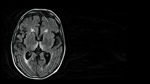 Kardiologische und  neurologische  Auswirkungen einer Alkoholerkrankung