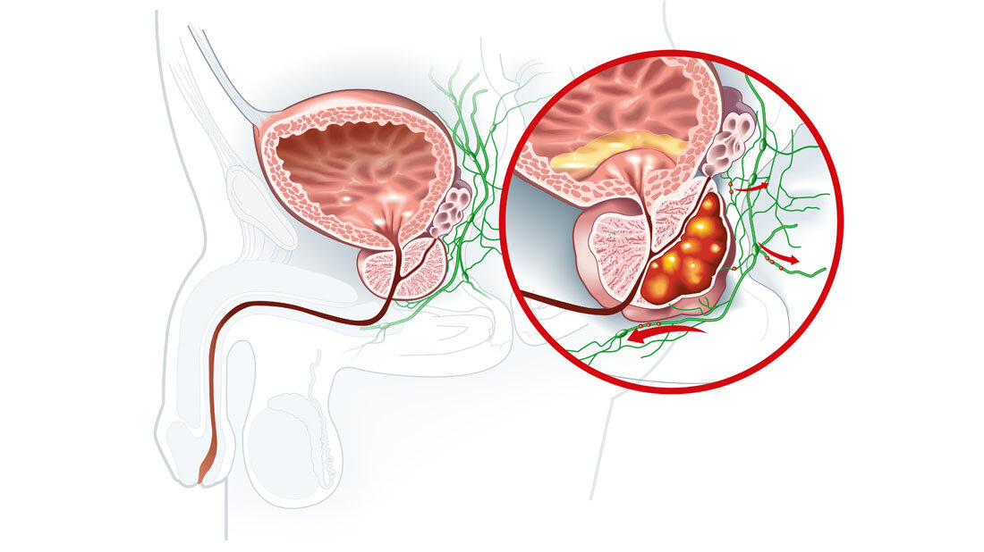 Schematische Darstellung von Prostatakrebs.