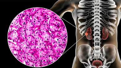 Erstmals nicht-klarzellige Nierenzellkarzinome 