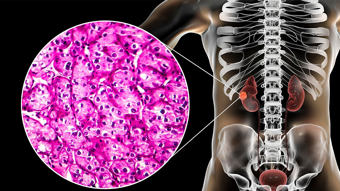 Erstmals nicht-klarzellige Nierenzellkarzinome 