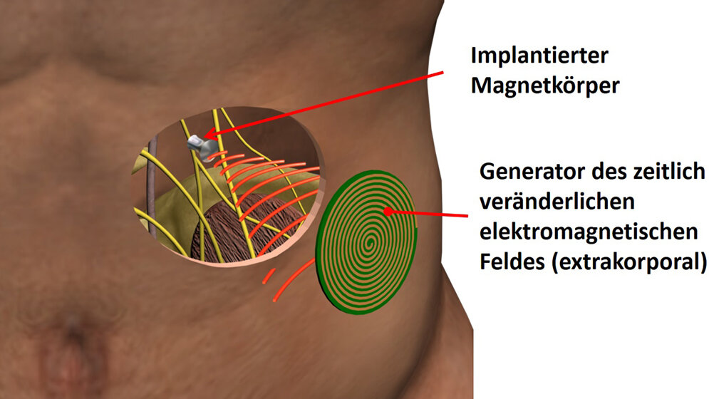 Prinzipskizze des Magnetoceuticals-Ansatzes