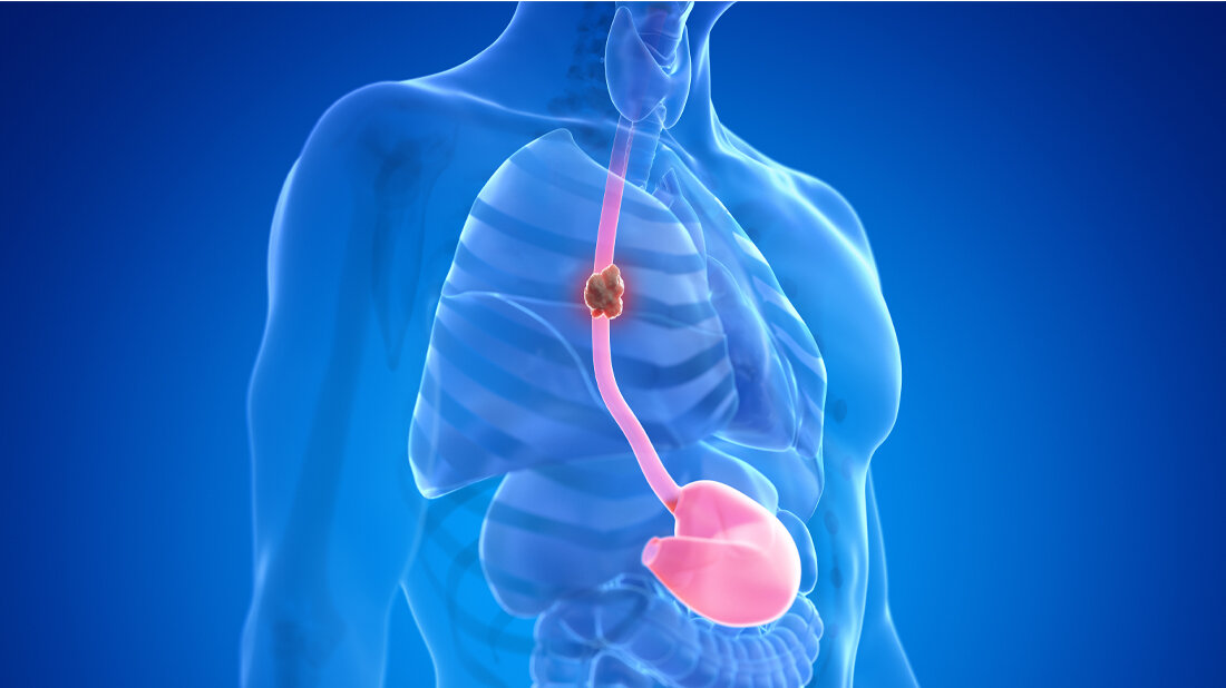 Studie zu Speiseröhrenkrebs