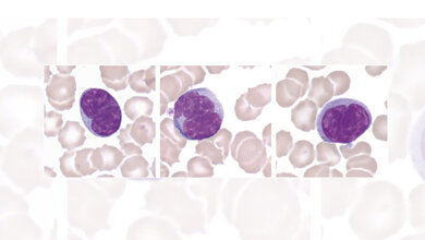 Hämatologie Lymphozyten mit gyriformen Kernen