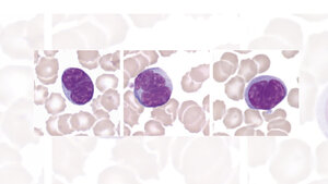 Lymphozyten mit gyriformen Kernen