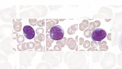 Lymphozyten mit gyriformen Kernen