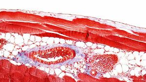 Postoperative Bauchrauminfektionen