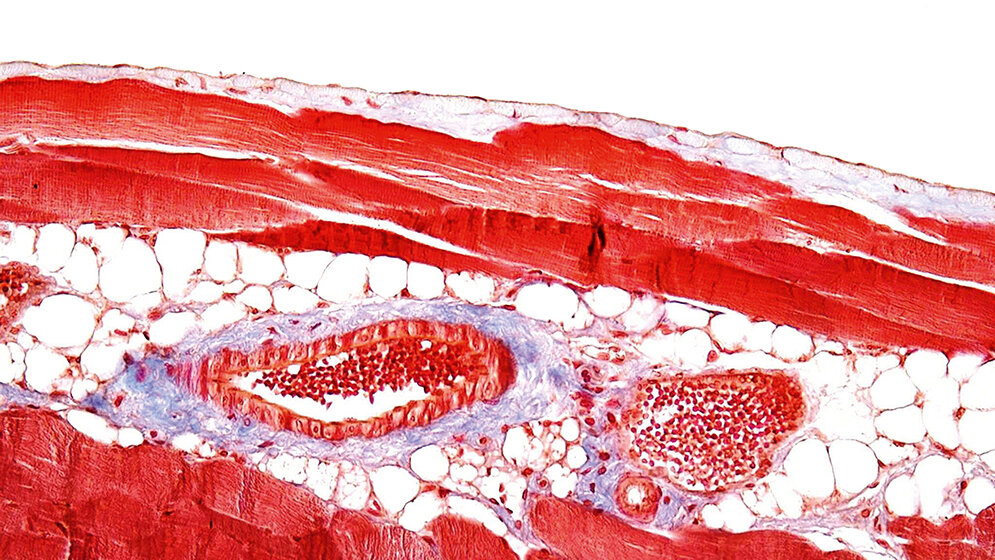 Postoperative Bauchrauminfektionen