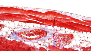 Postoperative Bauchrauminfektionen