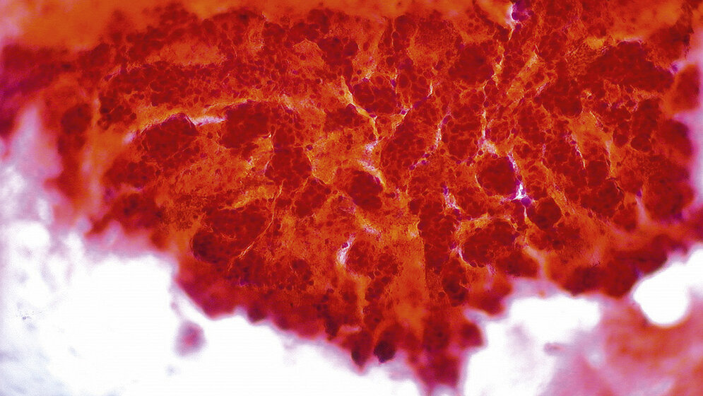 Selektive interne Radiotherapie (SIRT)