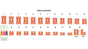 Grafische Darstellung der Trisomie 13