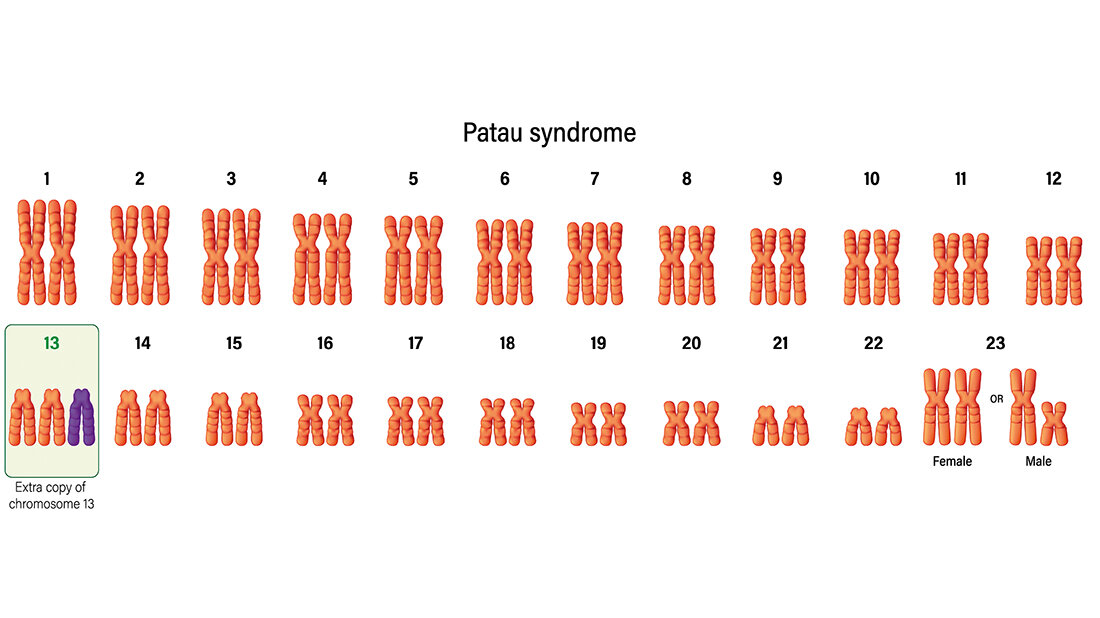 Grafische Darstellung der Trisomie 13