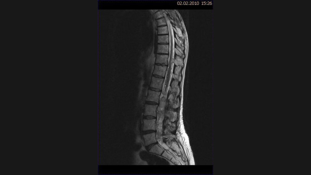 Hämangioblastom Schnittbilddiagnostik der Wirbelsäule (4.12)