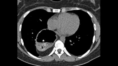 Titelbild zum Fachbeitrag zur Bildgebung bei intrathorakaler Magen-Darm-Luxation
