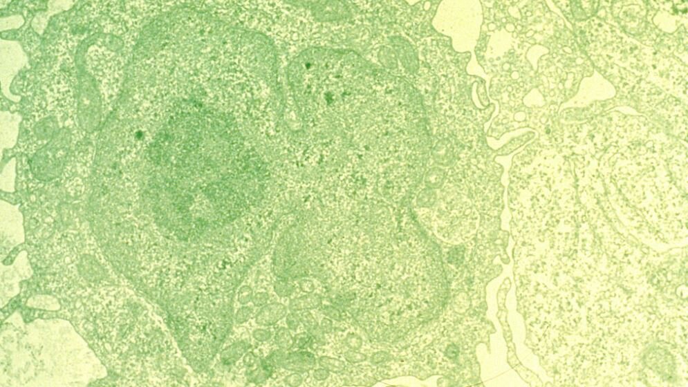 Hairy_cell_leukemia_Unbekannter_Fotograf_Public_domain_via_Wikimedia_Commons_21032016.jpg Haarzell-Leukämie