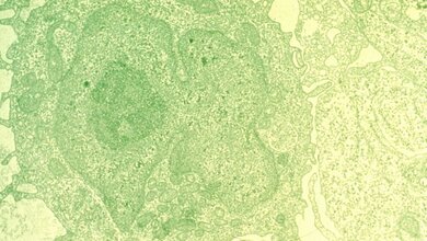 Hairy_cell_leukemia_Unbekannter_Fotograf_Public_domain_via_Wikimedia_Commons_21032016.jpg Haarzell-Leukämie