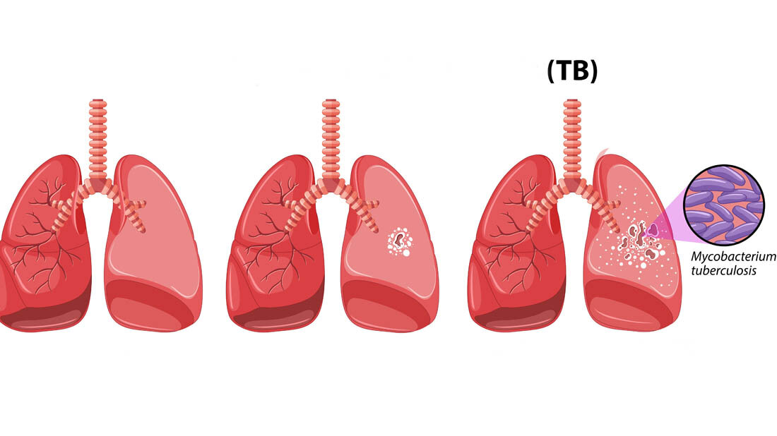 Schematische Darstellung gesunder Lunge und Lunge mit Tuberkulose