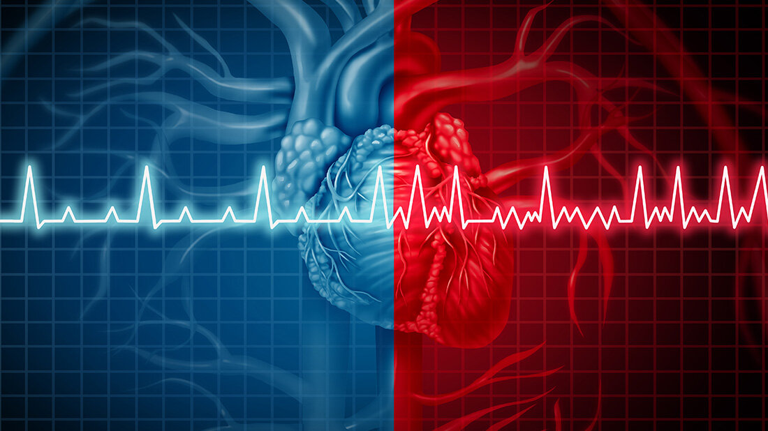 Schlaganfall nach Vorhofflimmern