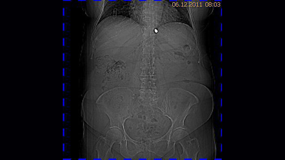 Schnittbilddiagnostik der Wirbelsäule (3.9)