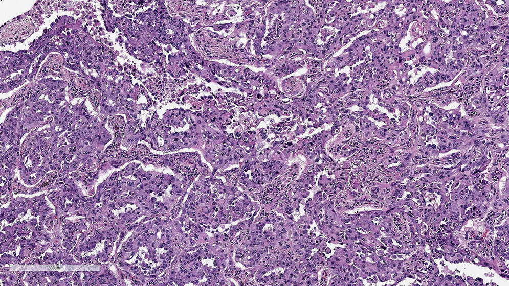 Optimierung und Validierung von PDL1-Färbeprotokollen am Beispiel E1L3N