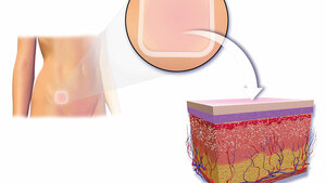 Transdermale Pflaster