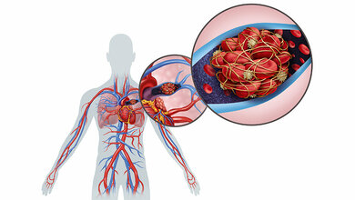 Lungenarterienembolie in der Computertomografie (Teil 1)