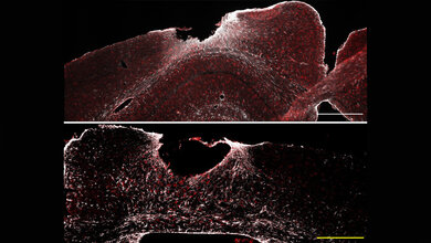 Bild von Wundheilung bei Schädel-Hirn-Trauma.