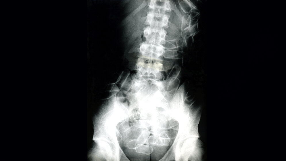 Bodypacker_Quelle_Zollfahndungsamt_Frankfurt_am_Main.jpg Bodypacker