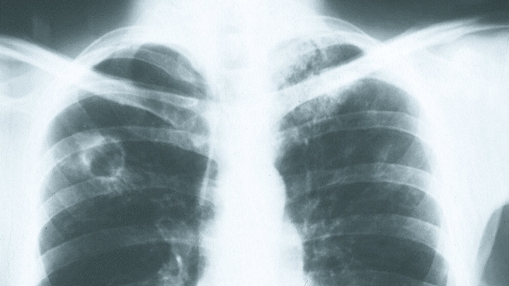 Tuberculosis in the workplace