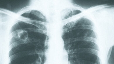Tuberculosis in the workplace