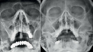 Anomalien und Normvarianten – Skelettale Veränderungen 3.9