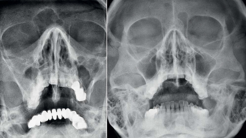 Anomalien und Normvarianten – Skelettale Veränderungen 3.9