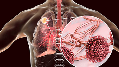 Schematische Darstellung eines Aspergillom