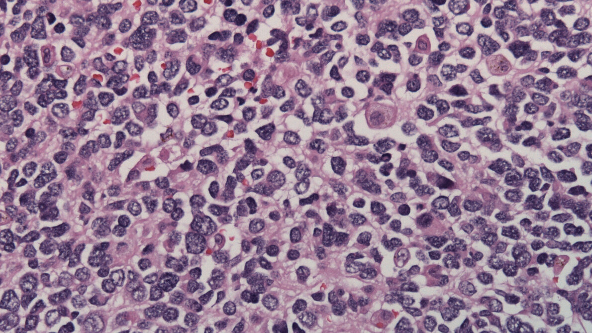 Neuroblastom