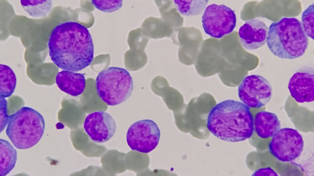 Neue_Blutkrebstherapie.jpg Neue_Blutkrebstherapie.jpg