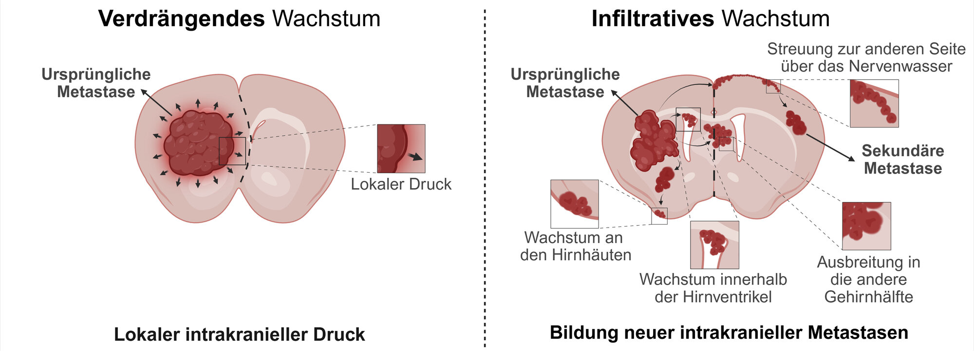 Grafische Aufbereitung der unterschiedlichen Verbreitung und des Wachstums von Hirnmetastasen