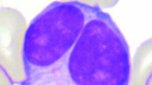 Zytologischer Nachweis zur Diagnose einer PPBL