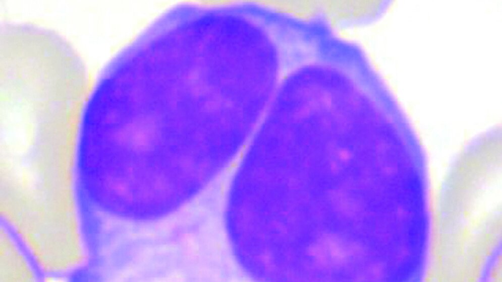 Binukleärer Lymphozyt Zytologischer Nachweis zur Diagnose einer PPBL