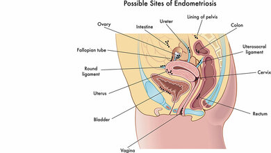 Titelbild zum englischen Fachbeitrag über Endometriose