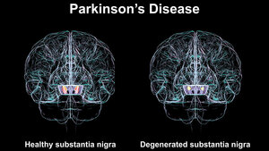 Vergleich gesunder mit degenerierter Substantia nigra 