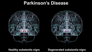 Vergleich gesunder mit degenerierter Substantia nigra 